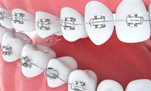 2022正畸托槽?行業(yè)發(fā)展現(xiàn)狀及前景分析