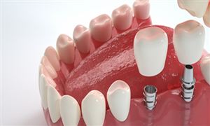 中國種植牙行業市場深度分析及發展前景展望