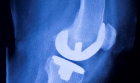 2023年中國骨科植入器材行業發展前景