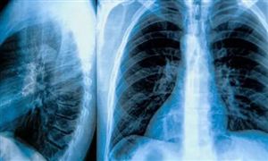 X射線細分市場發展 X射線行業發展前景及市場投資