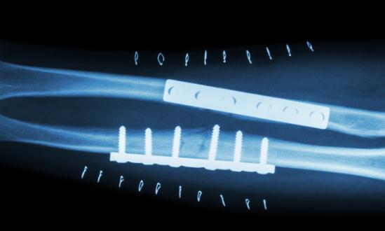 中國骨科植入器材行業發展趨勢 中國骨科植入器材行業供需分析